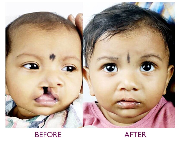 Nasoalveolar Molding for cleft orthodontics