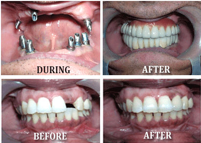 best orthodontics treatment in Bangalore