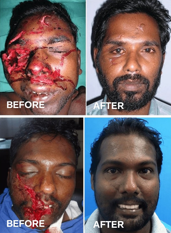 Best Facial Trauma Treatment In Bangalore