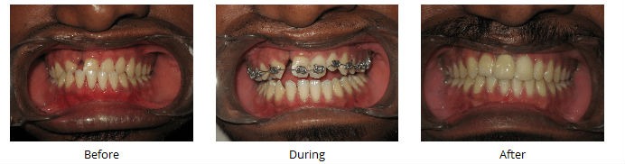 Metal brackets