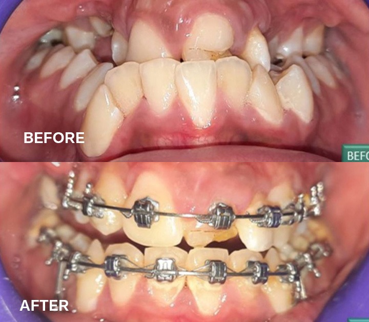Smile Arch protection with Pitts 21 brackets