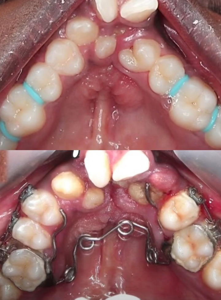Rapid Maxillary Expansion for Narrow Arch