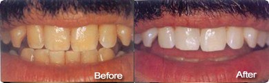 Teeth Whitening and Cleaning Treatment in Tamil Nadu