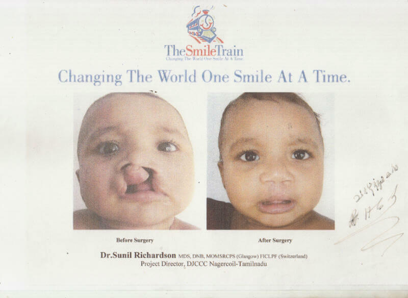 The Smile Train Nagercoil 1