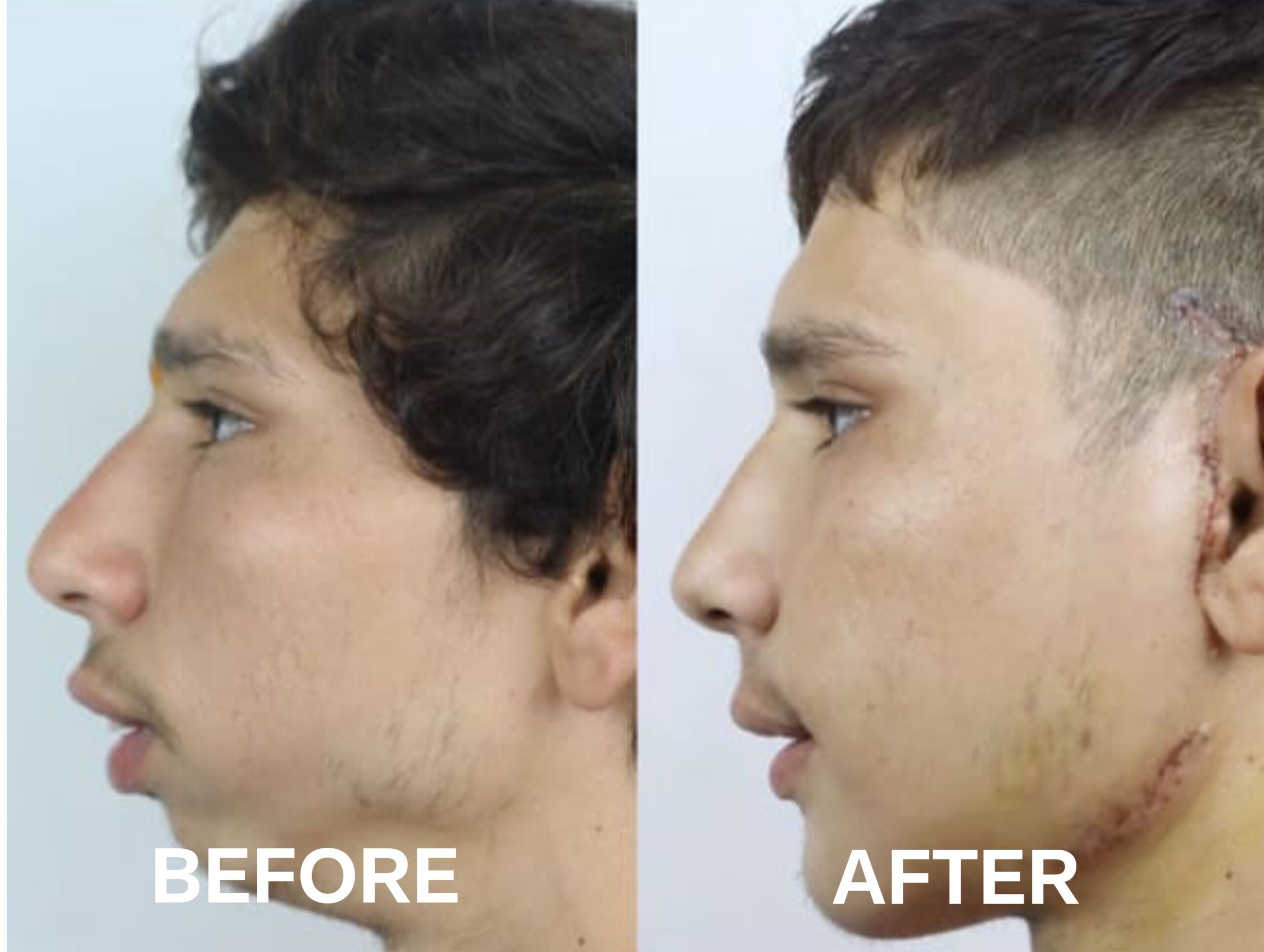 Cheek contouring