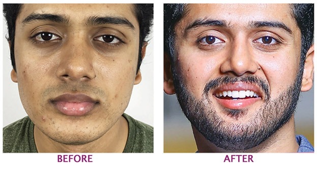 beared trabsplantation