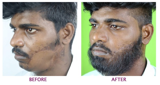 best hair transplant in Bangalore