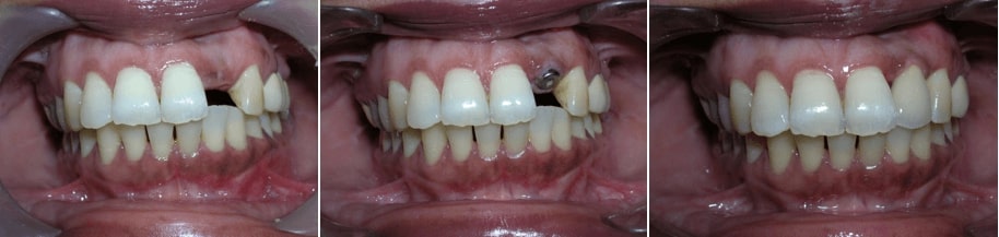 best dental implant treatment in india