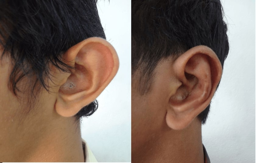 best otoplasty surgery in india