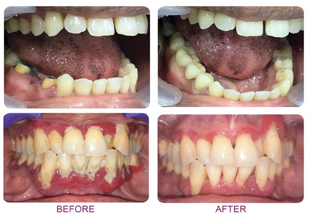 Ceramic brackets