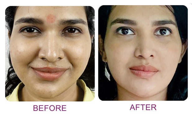 Laser Resurfacing