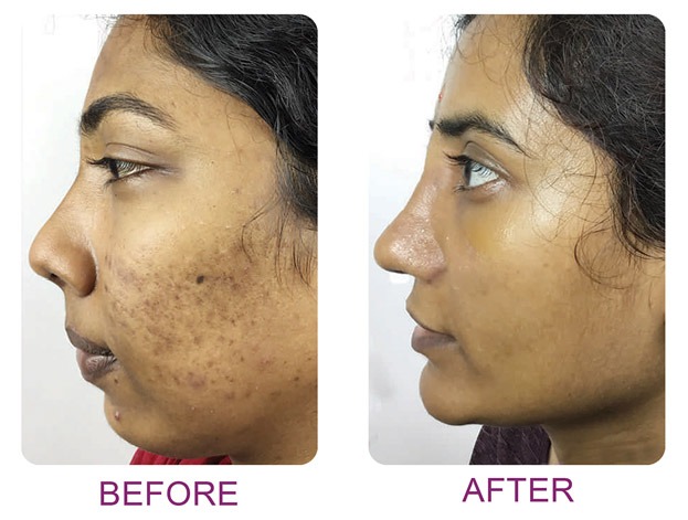 genioplasty 2