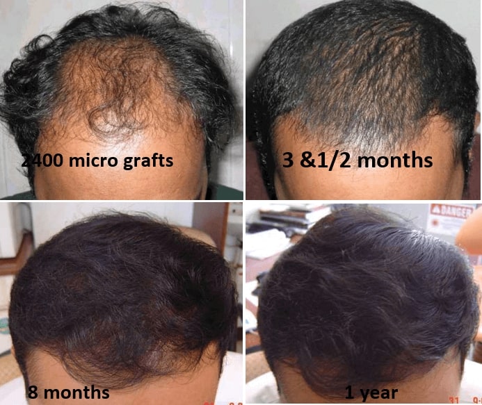 Best hair transplant in Bangalore