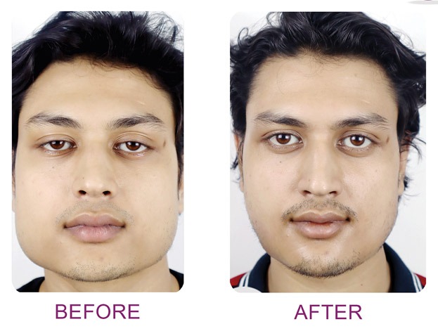 jaw sculpting