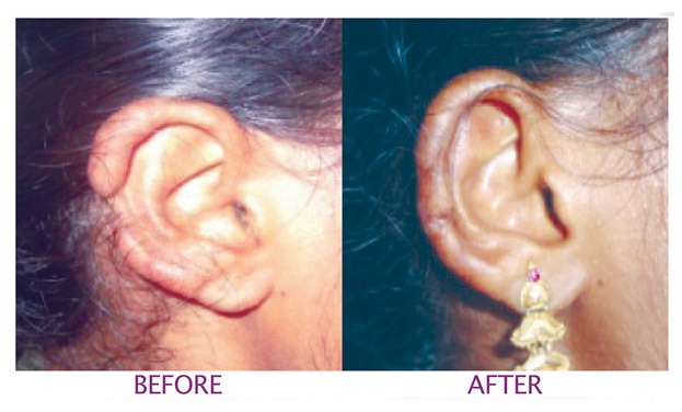 otoplasty 1