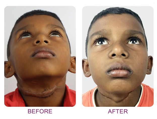 Facemask for growing children with midface deficiency