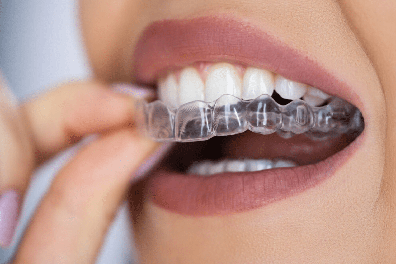 How Do Aligners Work?
