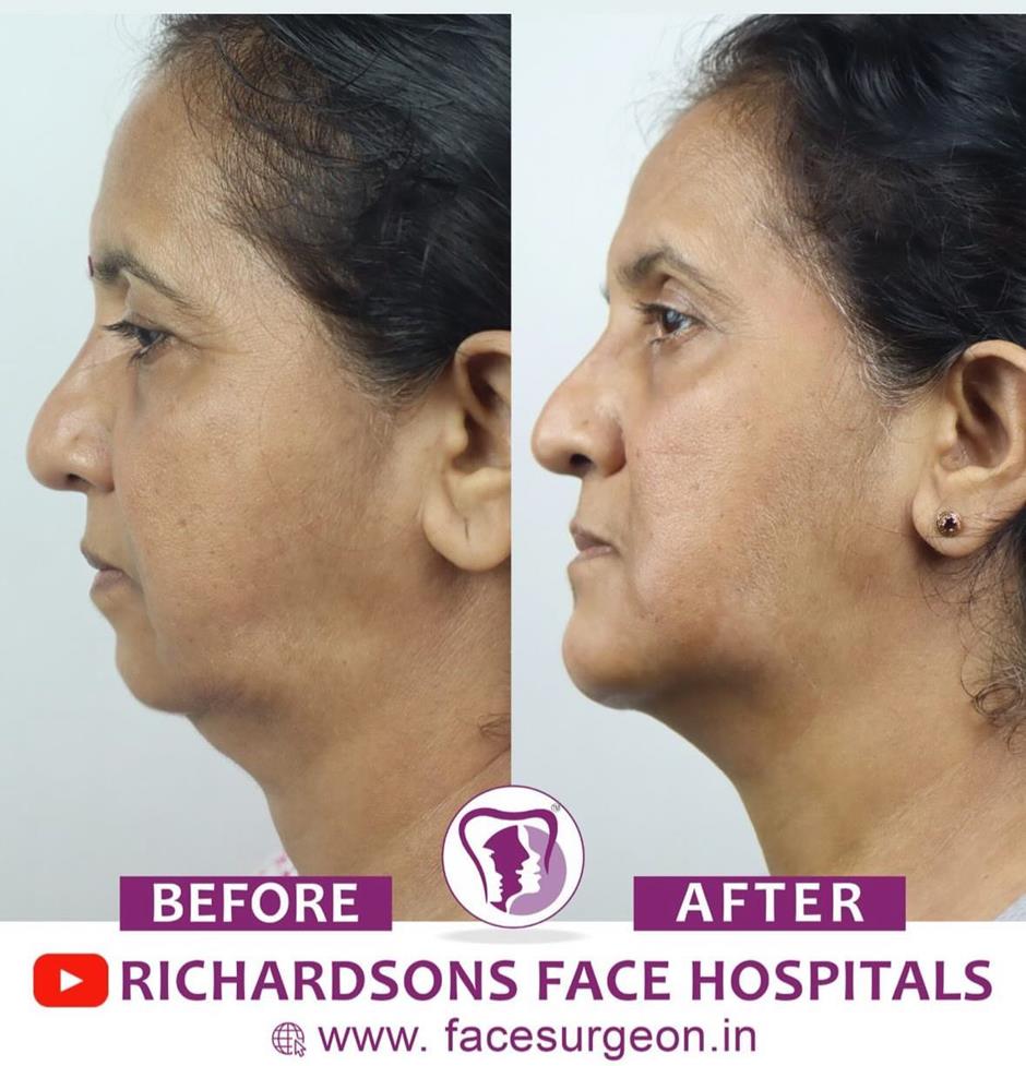 3D chin contouring surgery