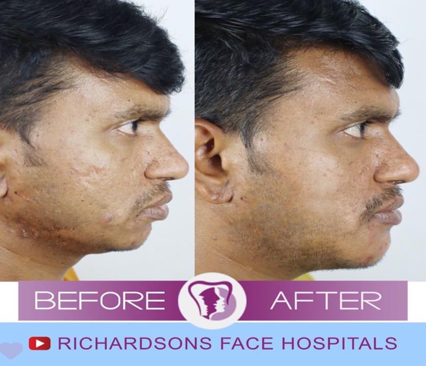 3D chin contouring surgery