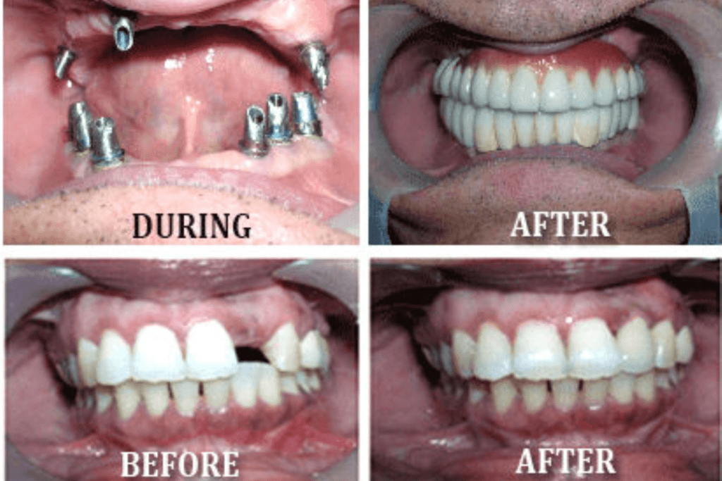 self-ligation brackets
