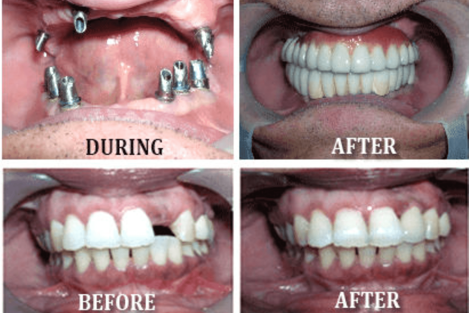 self-ligation brackets