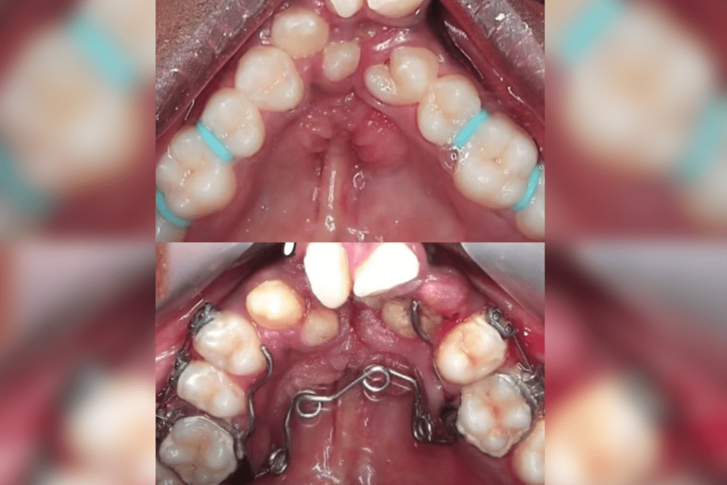 lingual orthodontics