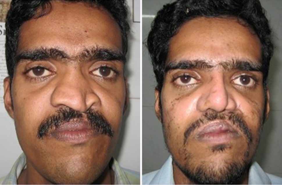 Alloplastic Rhinoplasty