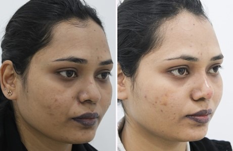 Liquid Rhinoplasty