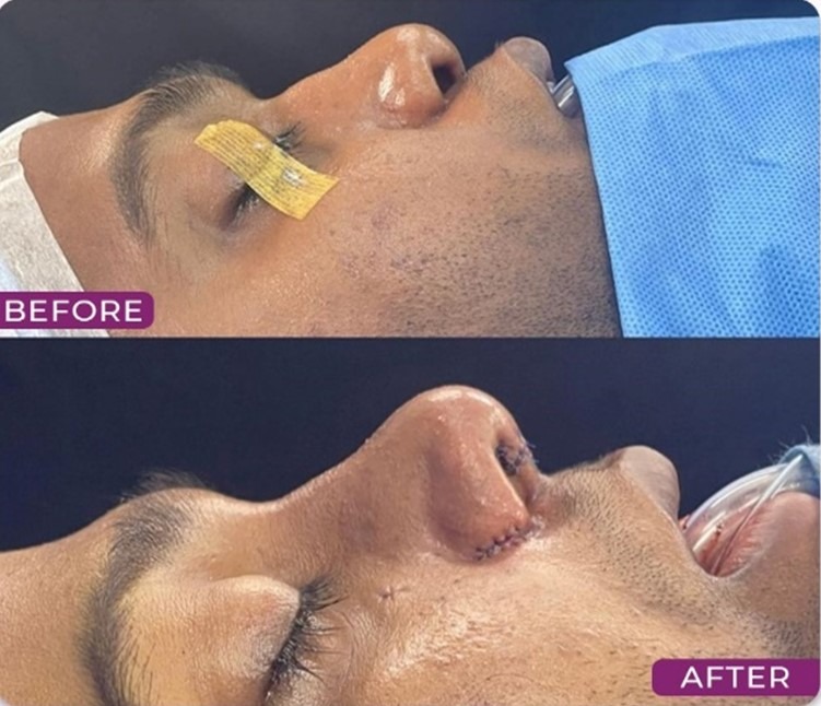 Open Structure Rhinoplasty