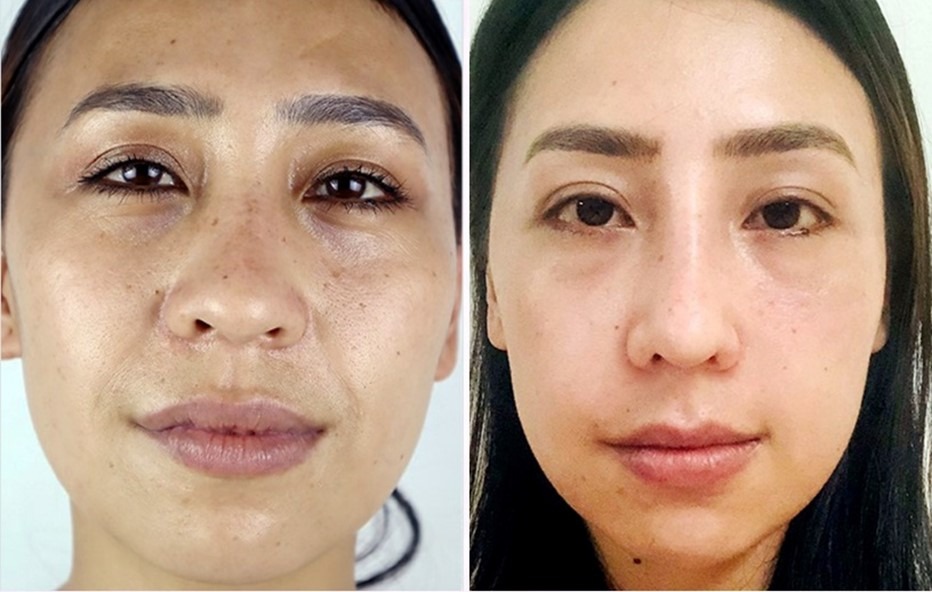 Closed Rhinoplasty