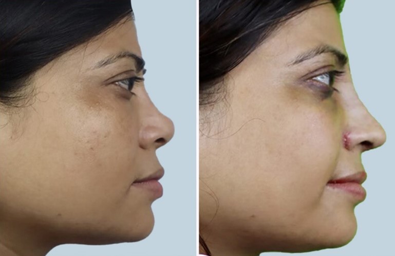 Atraumatic Rhinoplasty