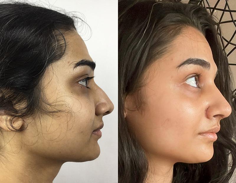 Functional Rhinoplasty or Nosejob