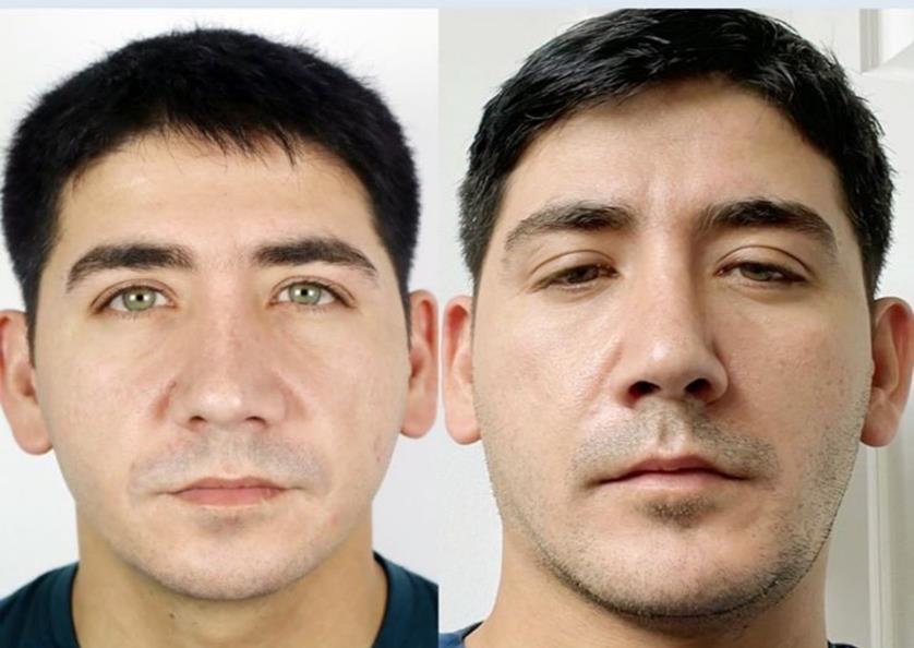 Nose job
