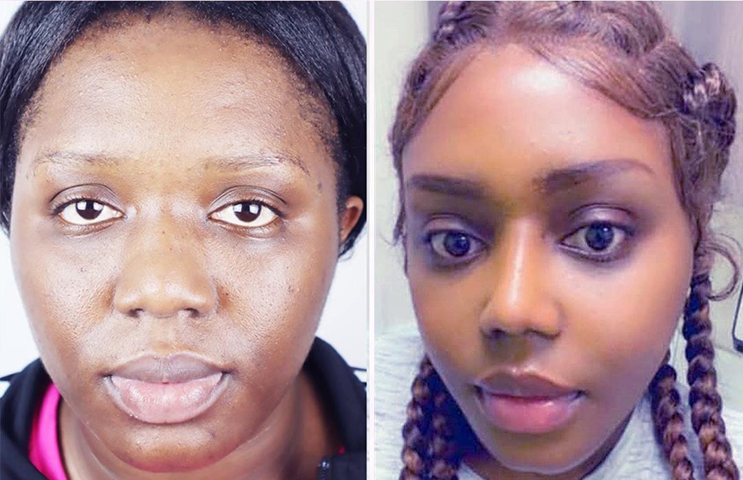 Ethnic Rhinoplasty