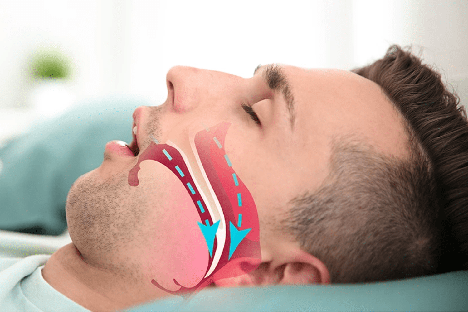 Sleep Apnea.