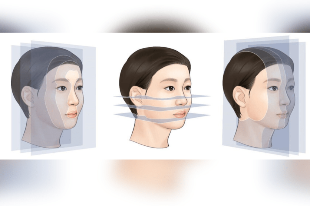 3D Chin Contouring Surgery