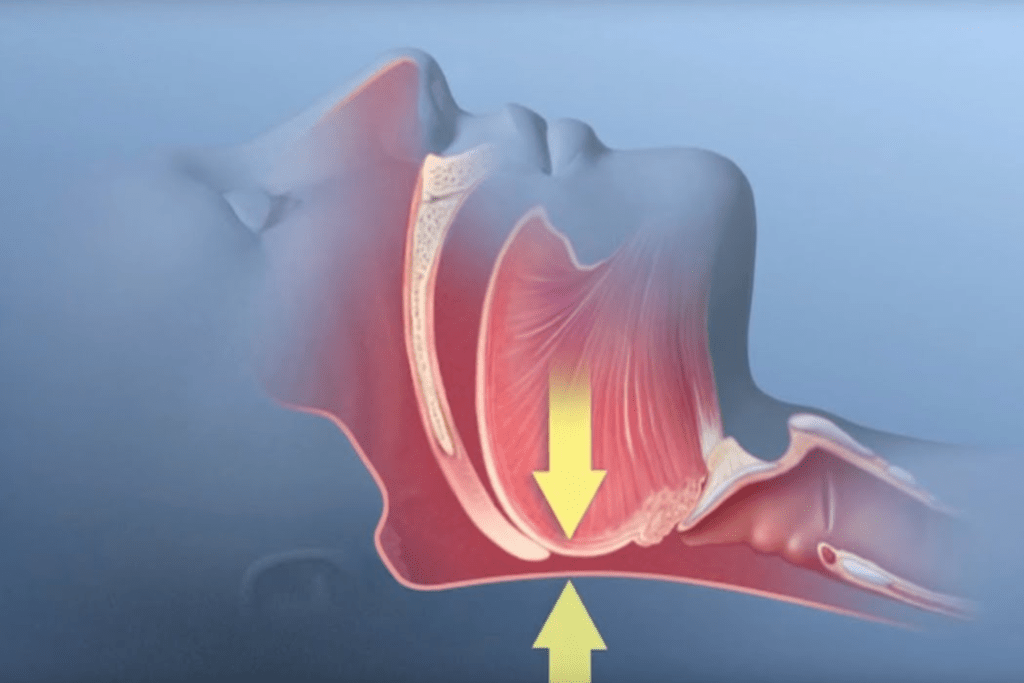 Obstructive Sleep Apnea