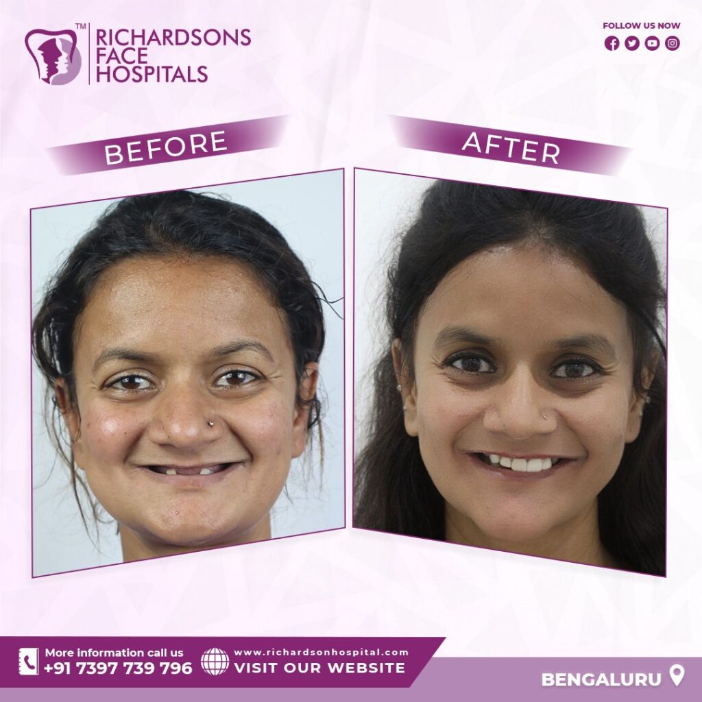 Best Dental Implants In Bangalore​