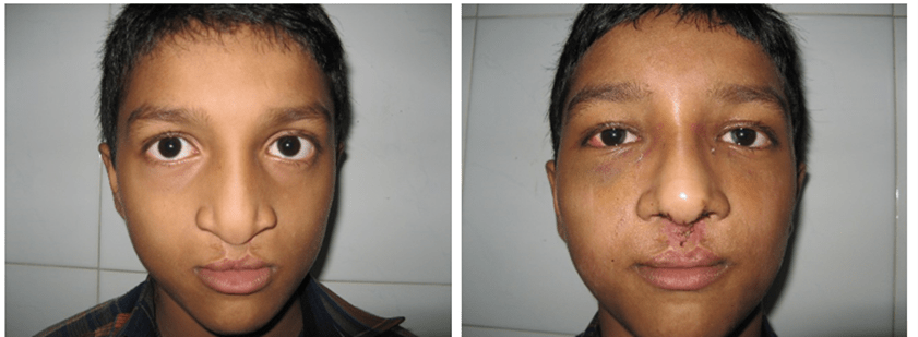 Preschool Rhinoplasty