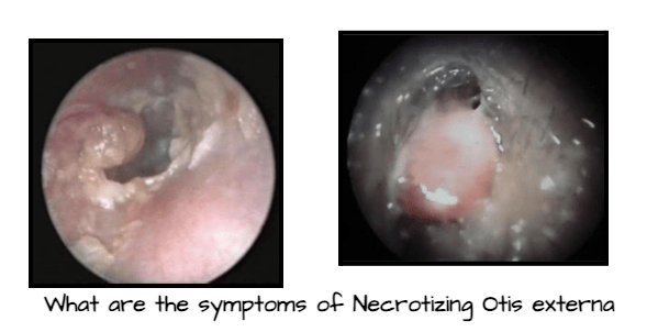 Diabetic Ear blog