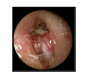Diabetic Ear blog1