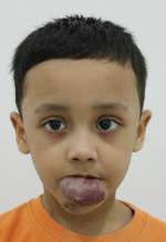Analysis Of Hemangioma Treatment