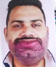 Analysis Of Hemangioma Treatment