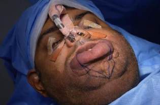 Analysis Of Hemangioma Treatment