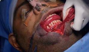 Analysis Of Hemangioma Treatment