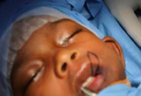 Analysis Of Hemangioma Treatment