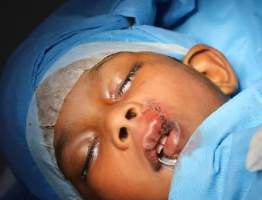 Analysis Of Hemangioma Treatment
