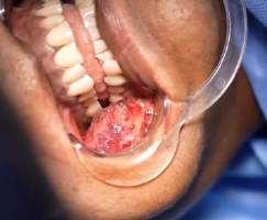 Analysis Of Hemangioma Treatment