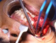 Analysis Of Hemangioma Treatment