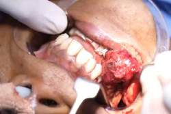 Analysis Of Hemangioma Treatment